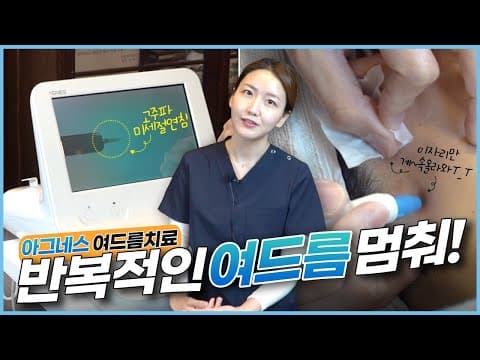특정 부위에 반복되는 여드름 치료하는 방법 _ 아그네스 피지선 파괴 레이저!🔥