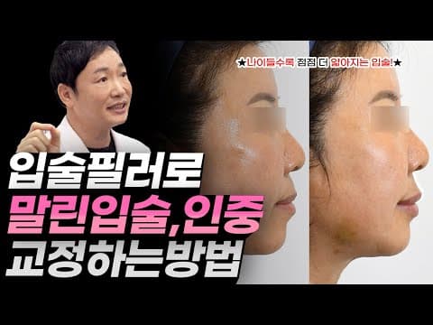 말린입술, 밋밋한 인중 입술필러로 교정하는 방법❗ (일반적인 입술필러 테크닉으로는 어려움)