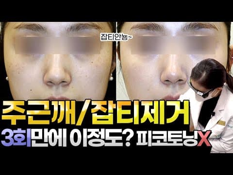 How to Treat Freckles, Blemishes, and Skin Brightening✨ Toning, IPL, Pico Laser, Alex Q—What Matt...
