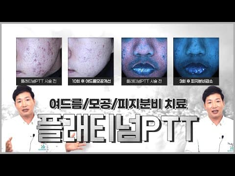 여드름치료 모공 피지억제 이걸로 종결? 백금!! 플래티넘PTT