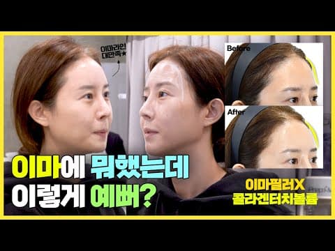 이마필러 아직도 헤매는 사람? 요즘 예쁜 이마는 이런 것!  콜라겐터치 이마 보여드릴게요.
