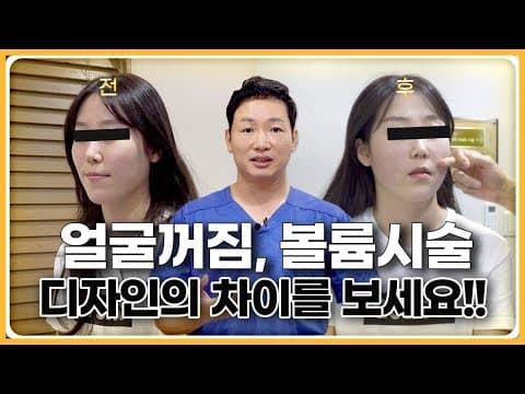 꺼진부위 볼륨시술로 채우고 더 작아진 얼굴?  feat.콜라겐주사