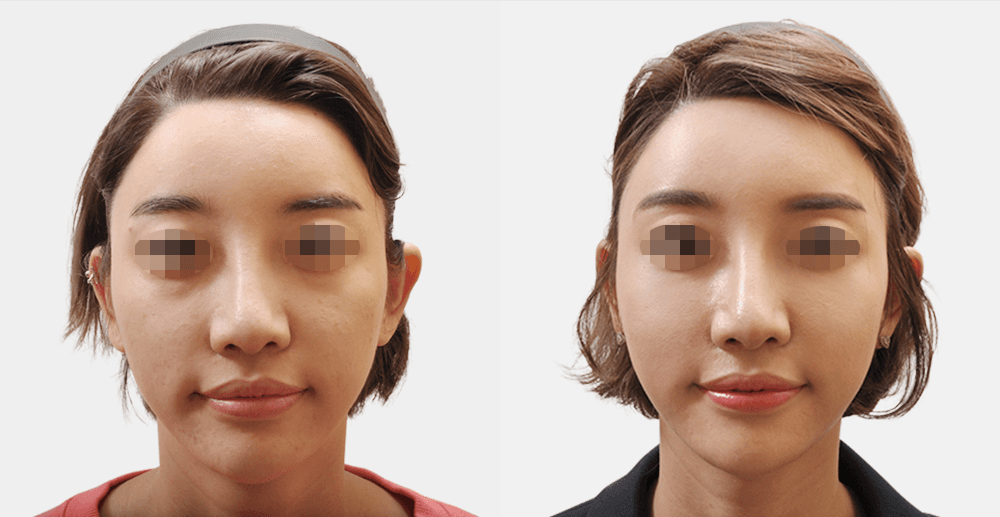 Collagen Injection #2 - 3 Months After