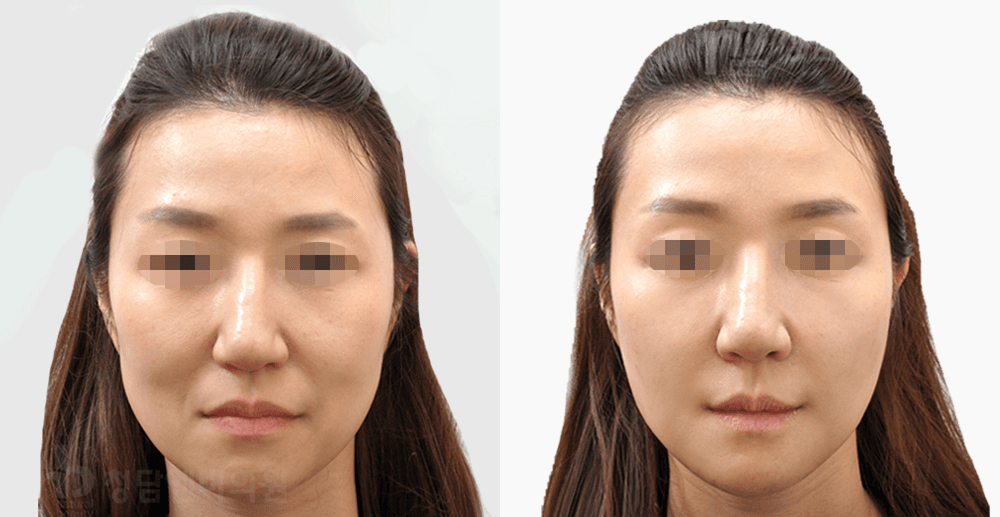 Collagen Touch #1 - 1 Month After