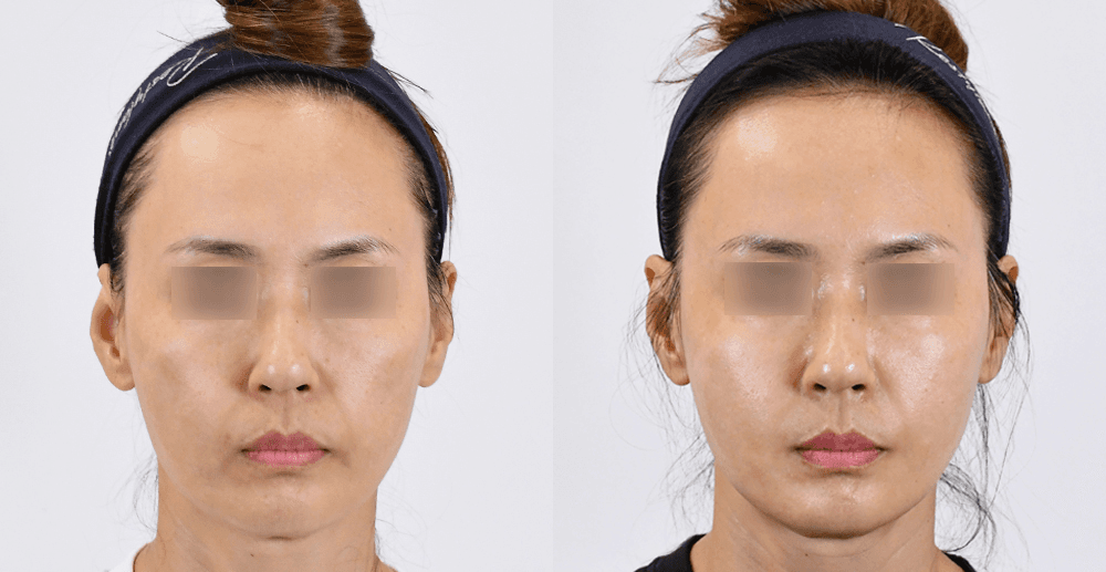 Collagen Touch #2 - 1 Month After