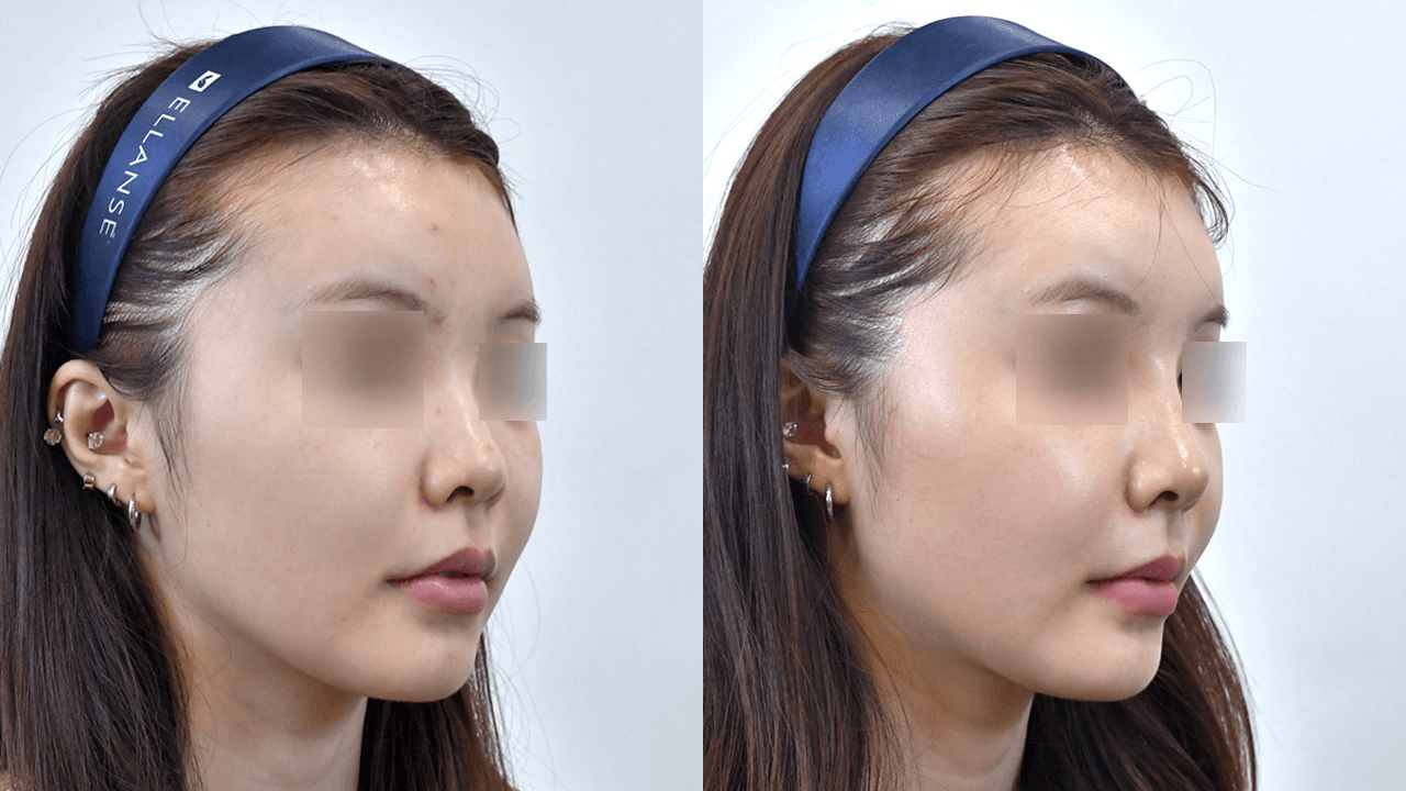 Magic Nose #1 - 1 Week After (45°)