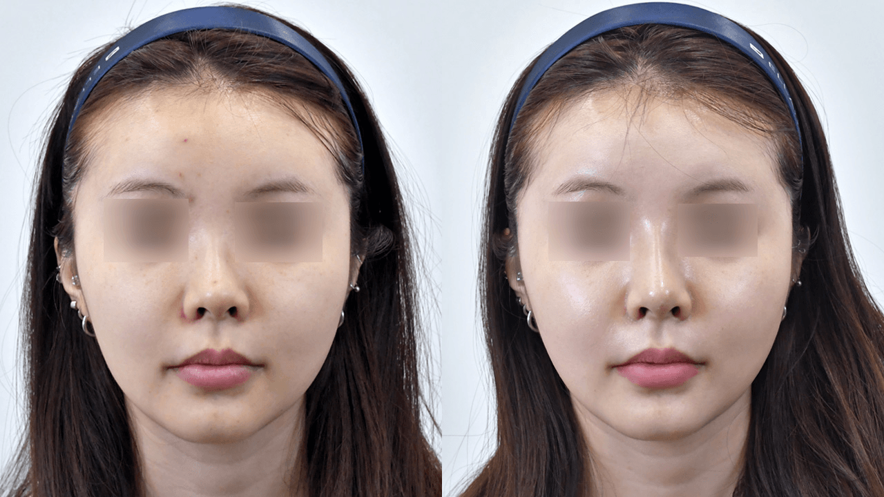 Magic Nose #1 - 1 Week After