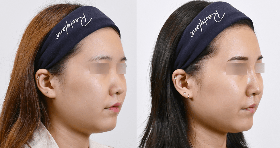 Magic Nose #2 - 1 Month After (45°)