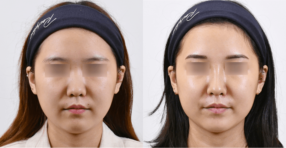 Magic Nose #2 - 1 Month After