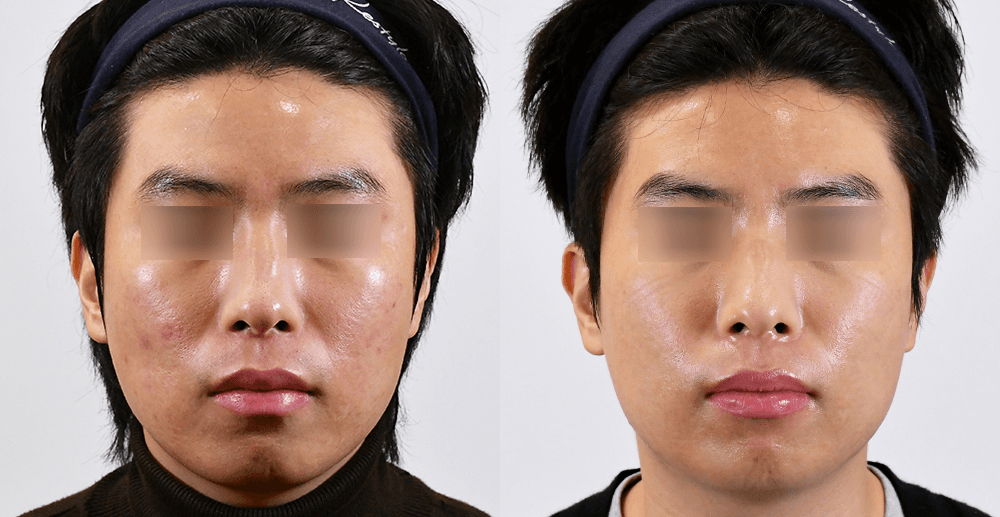 Scar/Pore #1 - 6 Months After