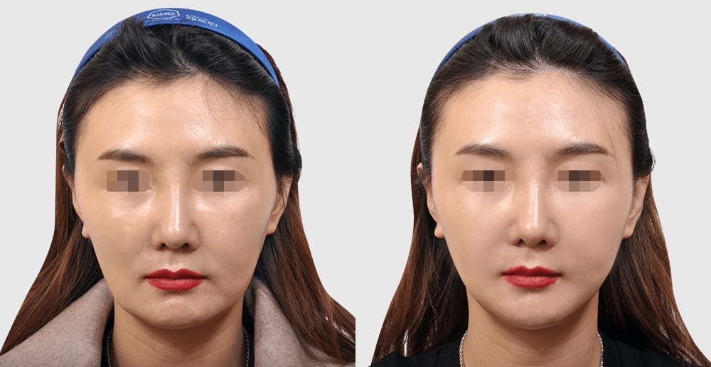 Thread Lifting #1 - 1 Year After