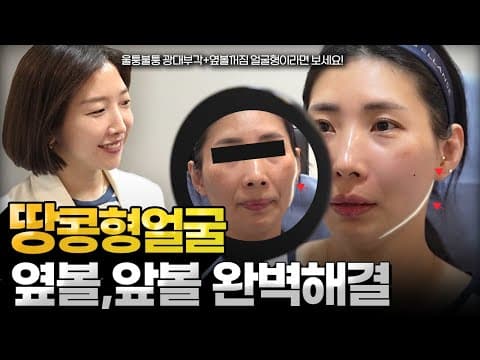 땅콩형얼굴 완벽개선, 광대부각 울퉁불퉁 ▶매끈한 얼굴형으로 (필러❌)