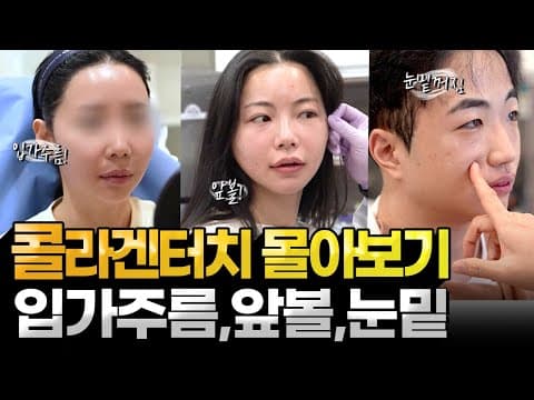 Collagen Injection & Collagen Touch Procedure Compilation Part 2 (Under-eye hollows, Mid-face vol...