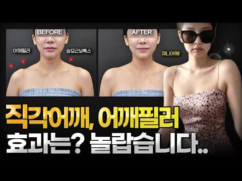 Shoulder Filler: How to Get Delicate, Square Shoulders✨ Before & After, Effects, and Who It's For...