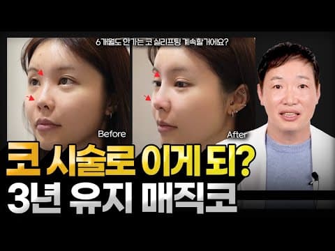 코 시술 전후 비교, 3년 유지되는 매직코! 6개월도 안가는 코 실리프팅 하지마세요