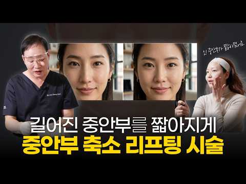 Is a Long Midface the Secret to Looking Older? 'Midface Reduction Lifting' to Look 10 Years Younger