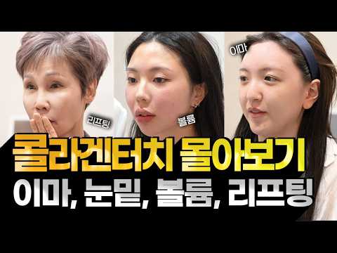 Collagen Injection & Collagen Touch Procedure Video Compilation Part 3 (Zip). (Forehead, Under-ey...