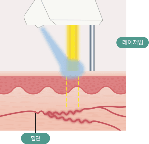 표피 냉각 보호 시스템